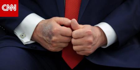 صحة ترامب.. لماذا تثير كدمات يد الرئيس الأمريكي الأكبر سناً التساؤلات؟