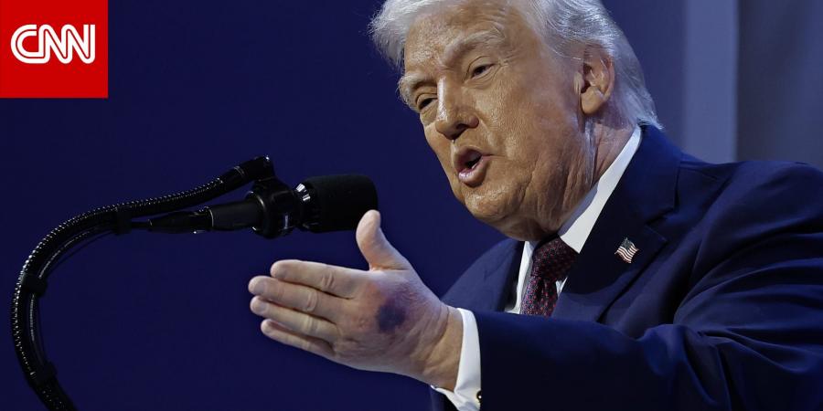 "لقد خدشتها".. ترامب يقدم "تفسيراً" لـCNN بشأن كدمة يده الكبيرة